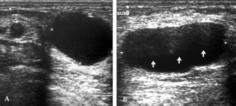 Ultrasound Of A 35 Year Old Lactating Woman Postpartum 6 Months With