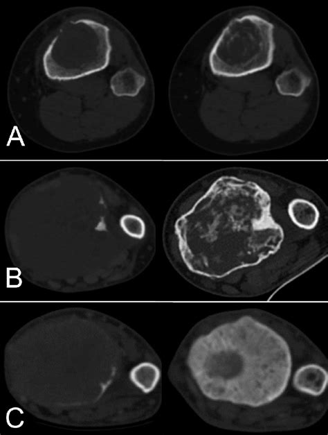 Computerized Tomography Ct Classification To Asses Gctb Changes After