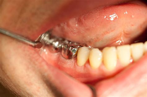 Die natürliche zahnkrone (lateinisch corona dentis) ist der teil eines zahnes, der aus dem zahnfleisch herausragt und mit zahnschmelz bedeckt ist, der härtesten im menschlichen körper vorkommenden substanz. קובץ:Krone unverblendet Zahn 46 IMG 6713.jpg - ויקיפדיה