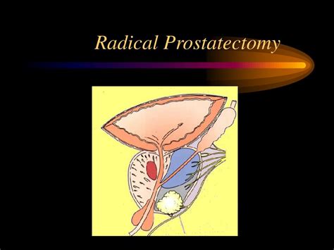 PPT Prostate Cancer PowerPoint Presentation Free Download ID