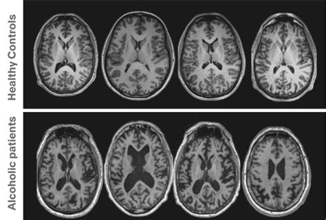 Brain Imaging For Psychiatrists Part Structural Static Measures