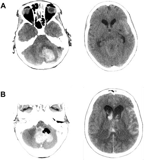 Case 2 Cranial Computerized Tomography Ct Scans A Pre Operative Ct