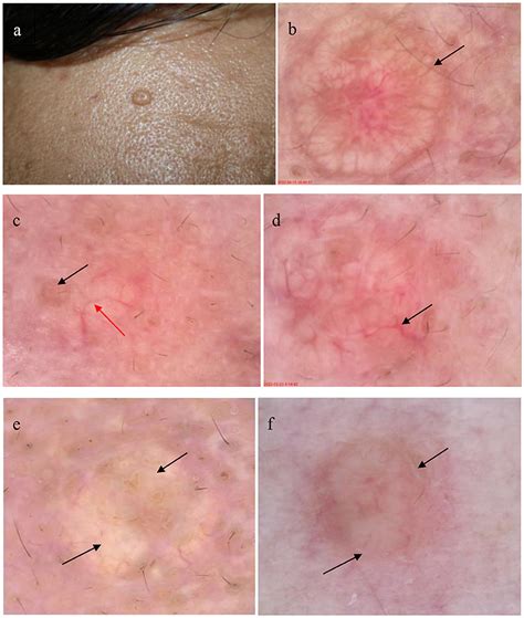 Frontiers Detection Of Sebaceous Gland Hyperplasia With Dermoscopy And Reflectance Confocal