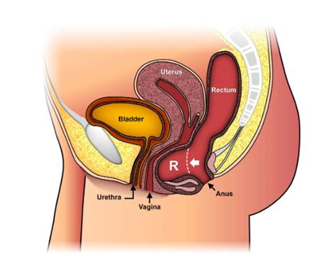 Can Pelvic Floor Therapy Help Rectal Prolapse Viewfloor Co