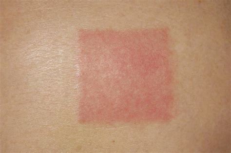 Skin Irritation From Transdermal Patch Photograph By Dr P Marazzi