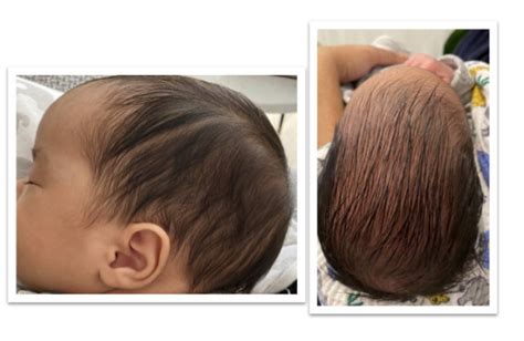 Help Elongated Baby Head Shape Babycenter