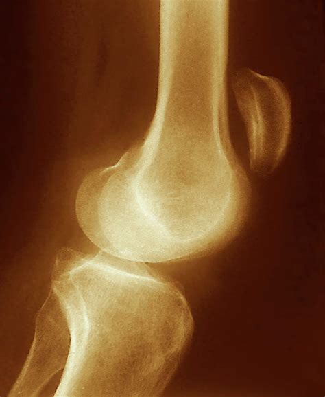 Dislocated Kneecap Photograph By Zephyrscience Photo Library Fine