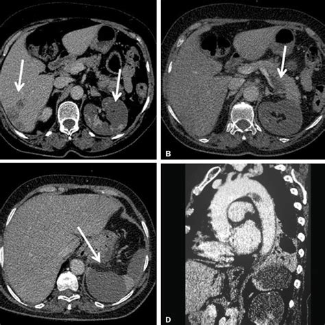 Contrast Enhanced Axial Ct Of The Abdomen Axial Sections Showing
