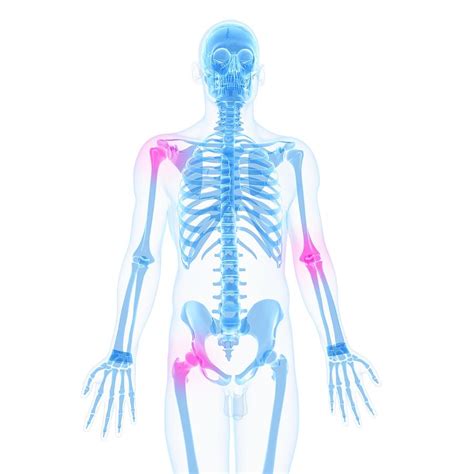 Joint Pain Conceptual Artwork 16 By Sciepro