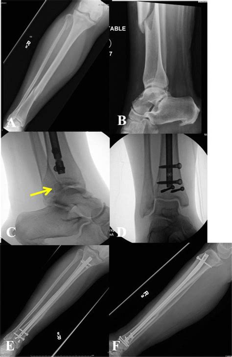 Right Distal Third Spiral Tibia Fracture A With Normal Appearing