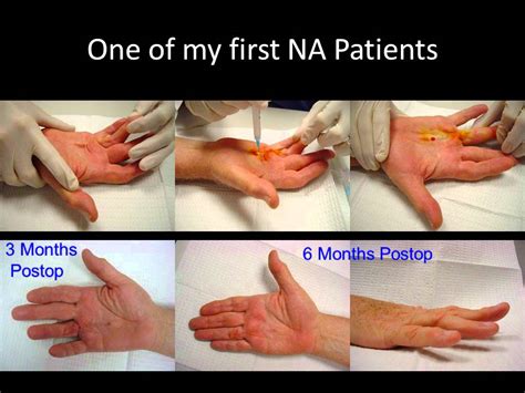 2010 Ifssh Needle Aponeurotomy Presentation Youtube