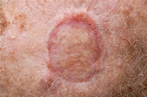Skin Graft After Squamous Cell Carcinoma Excision Stock Image C040