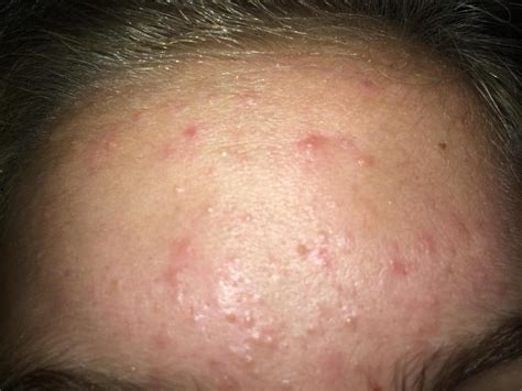 Small Bumps All Over Face And Cysts General Acne Discussion Acne