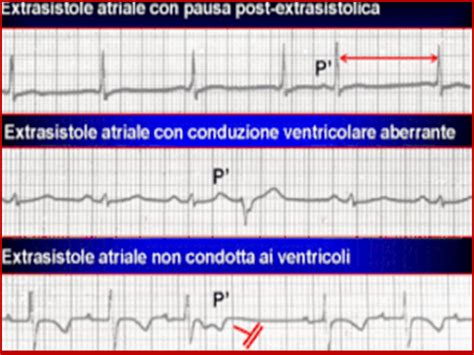 4° spazio intercostale, linea i ritmi defibrillabili. *Le aritmie cardiache - gennarino borrello