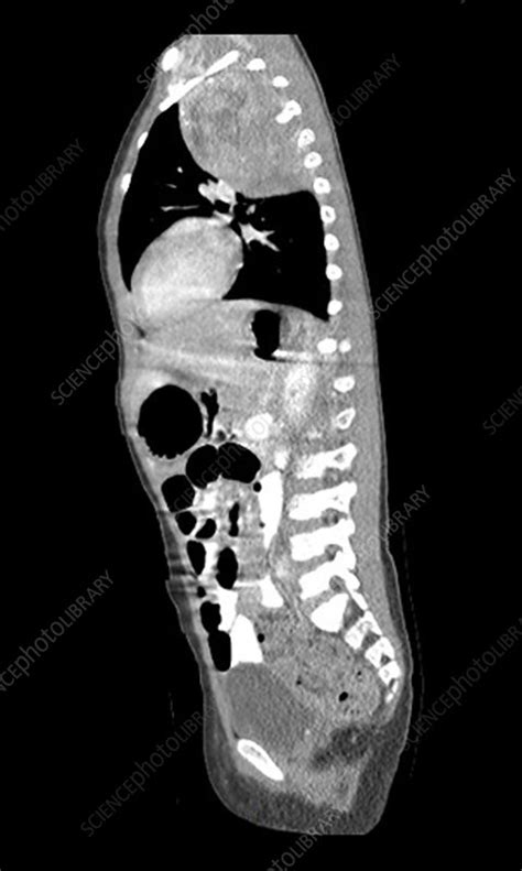 Neuroblastoma In Child Ct Scan Stock Image C0271796 Science