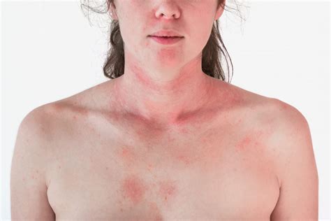 Unusual Causes Of Hives
