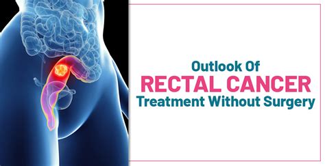 Rectal Cancer Icd 10 Archives Universitycancercenters