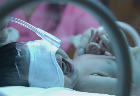 Neonatal Respiratory Distress Syndrome Causes Signs And Treatment