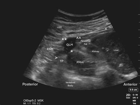 Abdominal Ultrasound In Transverse Orientation Image Acquired By