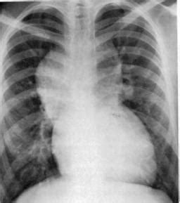 Review of clinical and pathological findings and results. Total Anomalous Pulmonary Venous Return / Connection ...