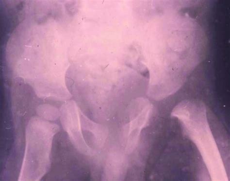 Osteomyelitis and septic arthritis | Obgyn Key