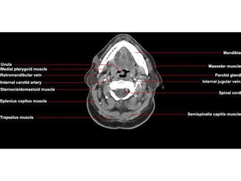 Ct Anatomy Of Neck Head And Neck Imaging Pinterest Anatomy