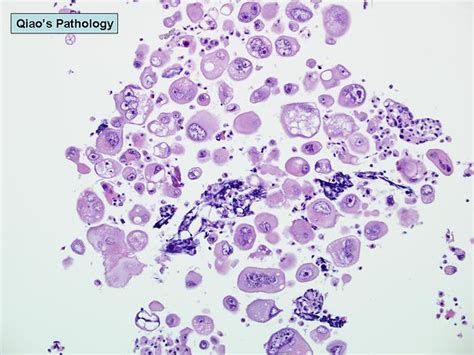 Qiaos Pathology Malignant Ascites With Peritoneal Carcinoma Cells