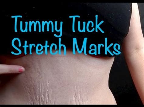 Tummy Tuck Stretch Marks YouTube