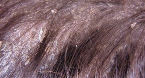 Treatments For Itchy Scalp Itchy Scalp Treatment Best Treatment For