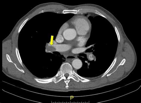 Cureus Cavitary Pulmonary Infarction In A Case Of Pulmonary Embolism After Successful Vascular