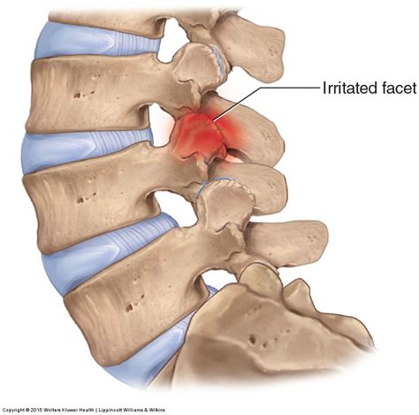 Facet Syndrome Of The Lumbar Spine