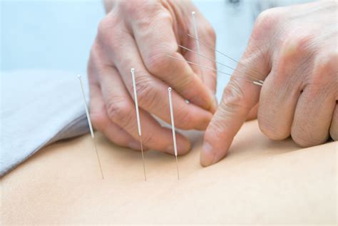 Acupuncture Treatment: How it Works, Benefits, and Risks