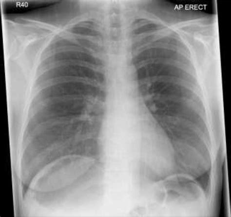 Chest X Ray Shows Air Under Diaphragm Due To Chilaiditi Syndrome