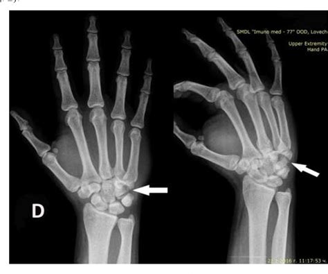 Pdf Fracture Of Hamate Bone Case Report Semantic Scholar