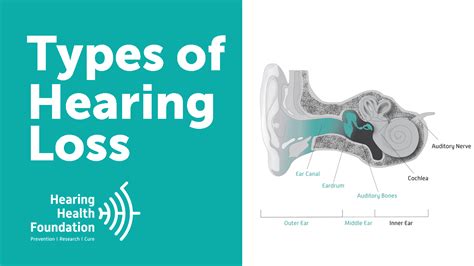 Types Of Hearing Loss — Hearing Health Foundation