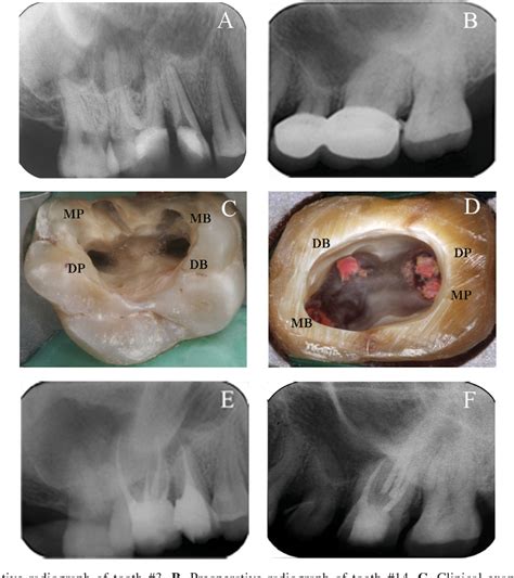 Endodontic Treatment Of Maxillary First Molars Presenting With Unusual
