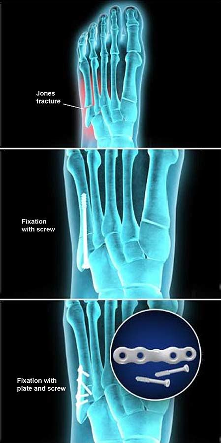 Jones Fracture Fixation Open Reduction And Internal Fixation