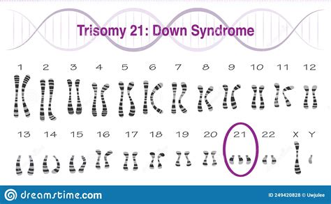 Trisomy Cartoons Illustrations Vector Stock Images 143 Pictures To