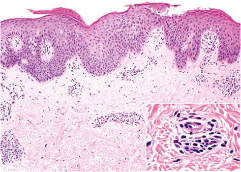 Punch Biopsy From The Left Flank Mild Acanthosis And Spongiosis With