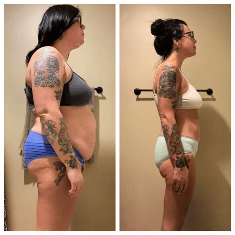 Gastric Sleeve Before And After