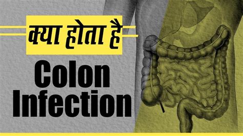What Is Colon Infection Causes Symptoms And Treatment Watch Video