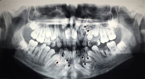 Non Syndromic Multiple Impacted Teeth Two Case Reports Biomedical