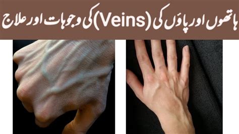 How To Get Ride Of Hands And Body Veins Naturally Hands Veins