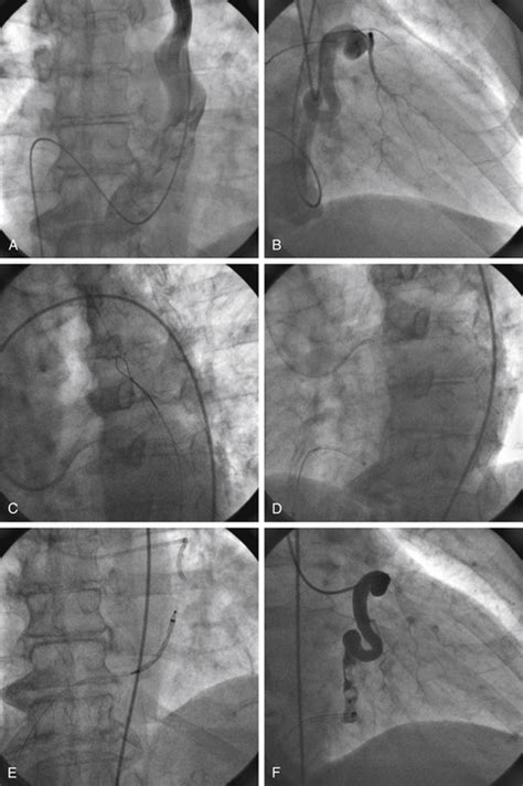 Percutaneous Closure Of Aortic Coronary And Ventricular