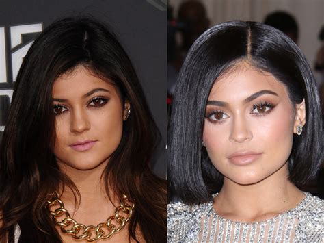 Lip Fillers What Are They And What Do They Feel Like