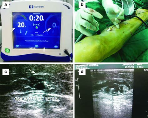 3 Radiofrequency Ablation Closurefast™ Catheter Of Great Saphenous