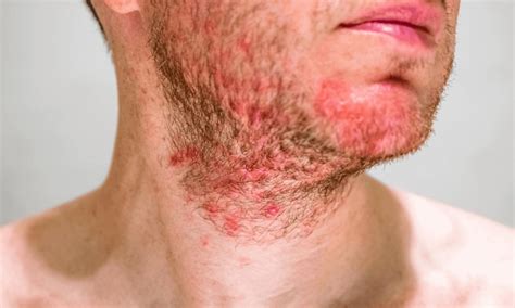Dermatite Seborroica Cause Sintomi E Rimedi