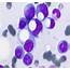 Rare Incidence Of Signet Ring Plasma Cells In Myeloma  MEDizzy Journal