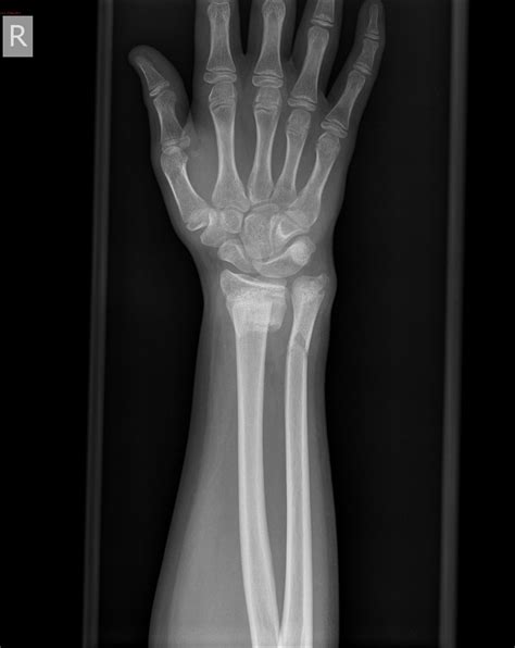 Forearm X Ray Anatomy