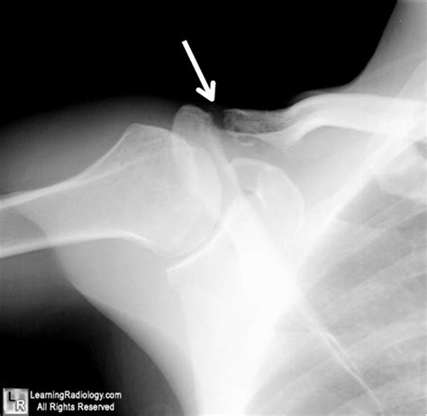 50k Shoulder Injury Learning Radiology Clavicle Clavicular
